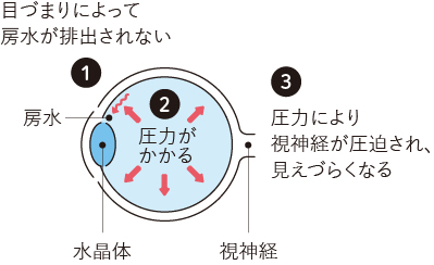 緑内障イメージ