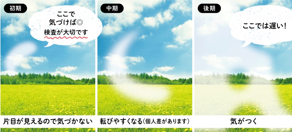 緑内障って？
